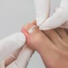 Namestitev sponke za vraščen noht Lepotni center Aloe Vera Ljubljana