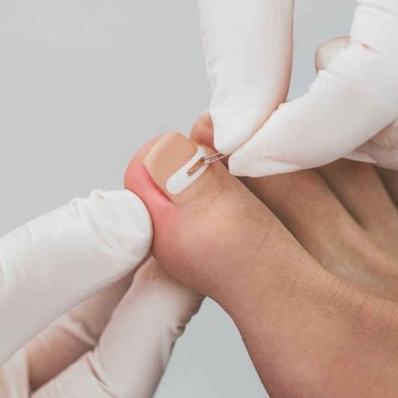 Namestitev sponke za vraščen noht Lepotni center Aloe Vera Ljubljana