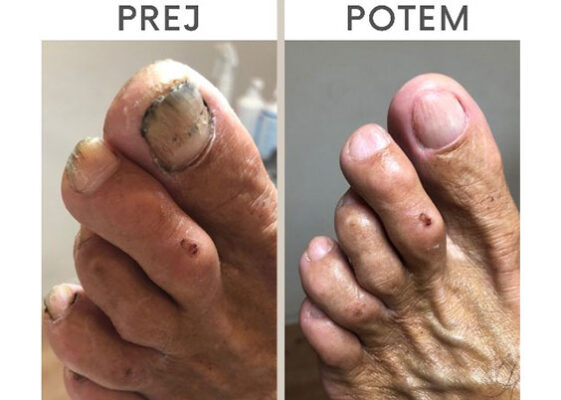 Medicinska pedikura za zdravje vaših stopal